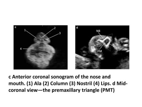 Fetal Anomaly Scan Ppt