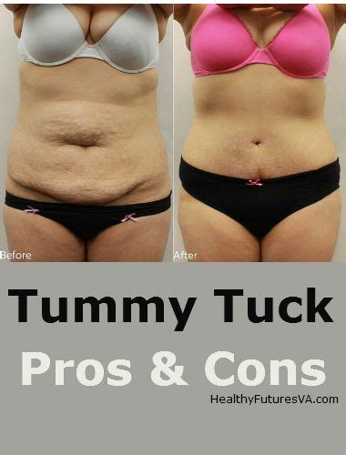 Weight Gain After Liposuction And Tummy Tuck Blog Dandk