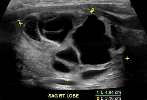 Assessment Of American College Of Radiology Thyroid Imaging Reporting