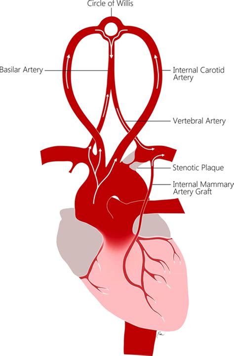 Subclavian Steal Syndrome Circulation