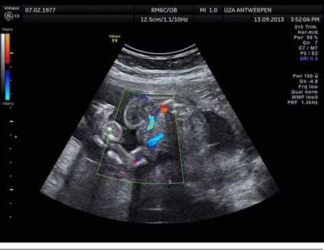 Figure 4 From Bladder Exstrophy Epispadias Complex And Triple X Syndrome Incidental Finding Or