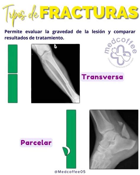 Tipos De Fracturas Medcoffee Udocz