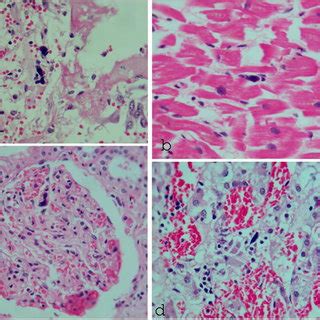 Naked Megakaryocytes In The Lung A Myocardial B Glomerular C