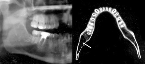 Cropped Panoramic Radiograph And Axial Ct Slice Case 6 Showing An