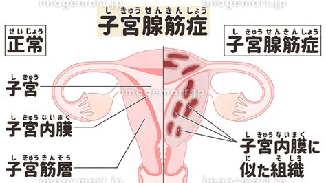 子宮腺筋症と健康な子宮の比較 わかりやすい日本語図解イラスト [255089445] イメージマート