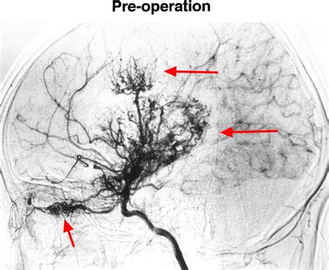 Moyamoya Disease Causes Symptoms Life Expectancy Treatment