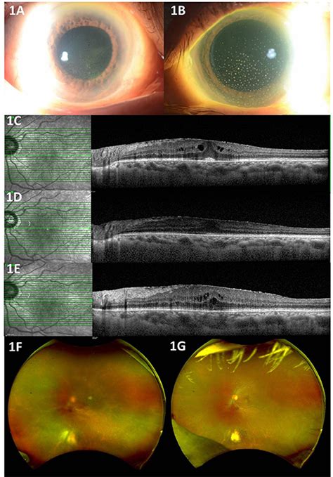 Frontiers Incidence Of Covid Vaccination Related Uveitis And