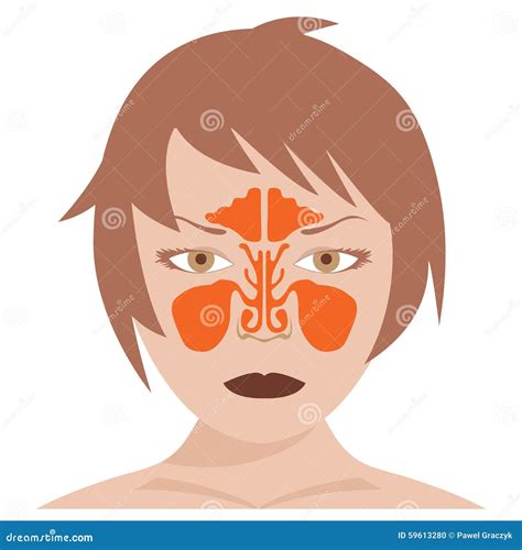 Normal Nasal Cavity Versus Rhinitis Anatomy Illustration