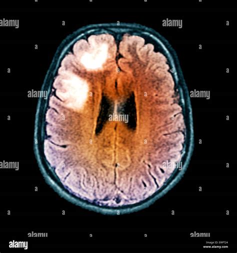 Irm Anormal Du Cerveau Banque De Photographies Et Dimages Haute