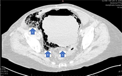 Ct Scan Transverse Plane Showing Emphysematous Cystitis A Bladder Download Scientific