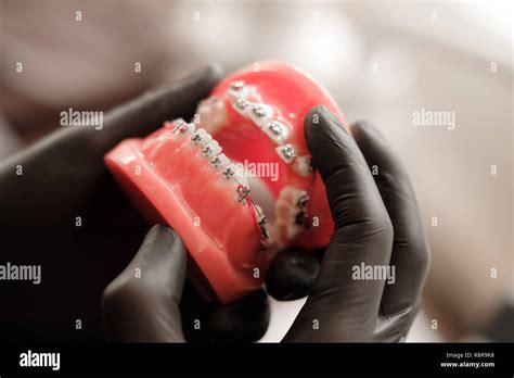 Dentist In Black Gloves Holding Dental Casting Model Human Jaws With