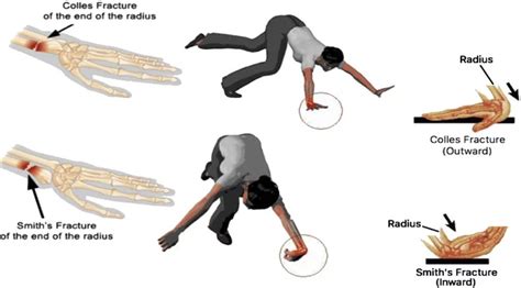 Radial Styloid Process Fractures Symptoms Treatment Rxharun