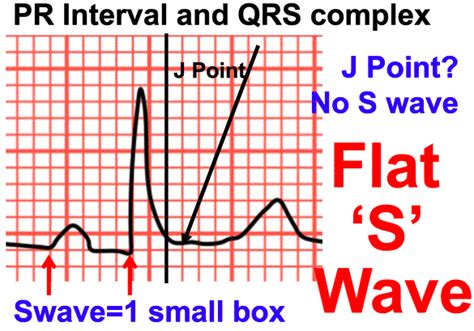 Normal Qrs Time