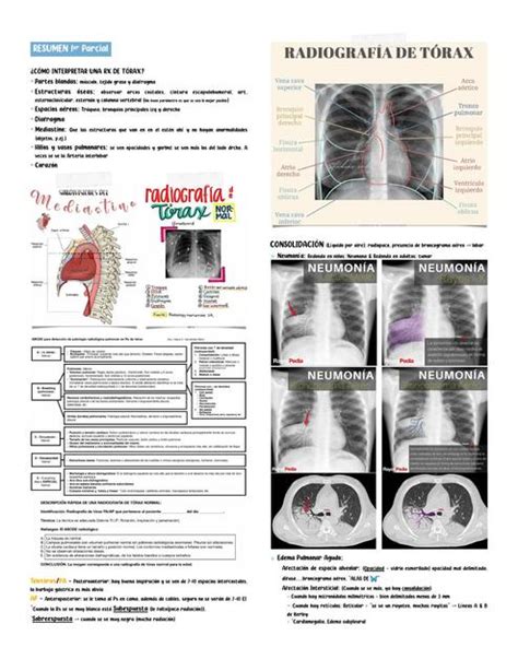 Resúmenes de Radiografía de tórax Descarga apuntes de Radiografía de