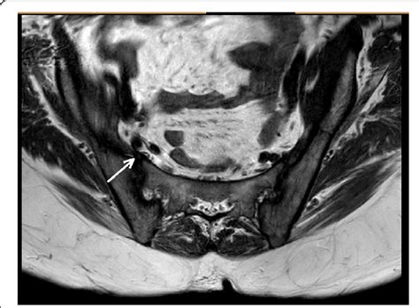 Sacroiliac Joint Dysfunction Mri