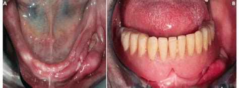 A Clinical View Of Mandible And A Large Epulis Fissuratum B