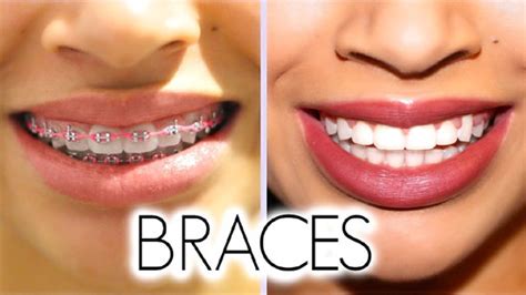 Process Of Getting Braces From Start To Finish