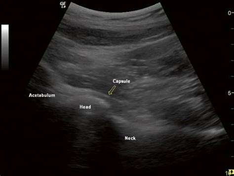 Hip Joint Injection Ultrasound