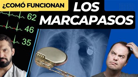 MARCAPASOS CARDIACO Cómo FUNCIONAN tipos e indicaciones YouTube