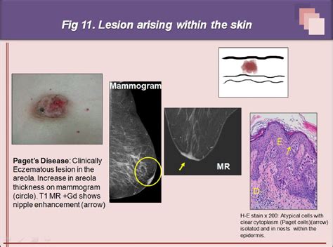 Figure From Superficial Breast Lesions A Comprehensive Review Of