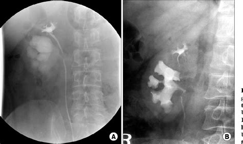 [pdf] Successful Endourologic Management Of Lower Pole Moiety Ureteropelvic Junction Obstruction