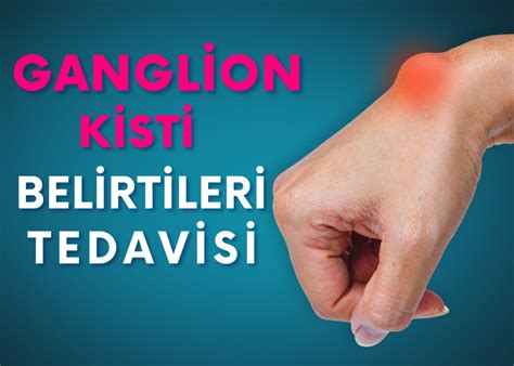 Ganglion Kisti Belirtileri ve Tedavi Yöntemleri Hakkında Merak