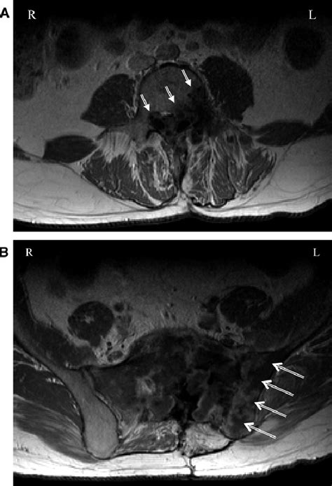 T Weighted Gadolinium Enhanced Mri Scans Months Before Surgery The