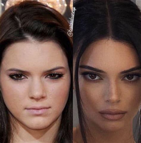 Kendall Jenner Picture: Kendall Jenner Before An After Surgery