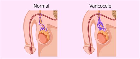 Tratamiento Natural Para Hidrocele Y Varicocele