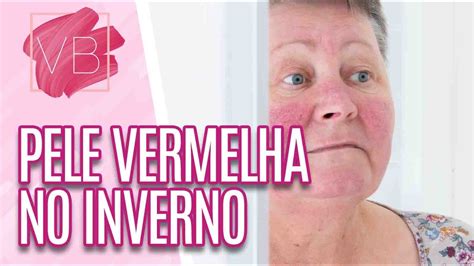 Como Amenizar E Tratar A Vermelhid O Na Pele Durante O Inverno Voc