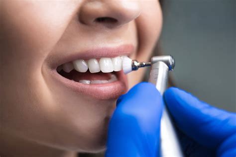 Limpeza Nos Dentes Como Feita E Quando Fazer