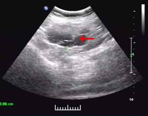 Abdominal Ultrasonography Showing An Abdominal Cystic Mass Of 6 9 Cm ×