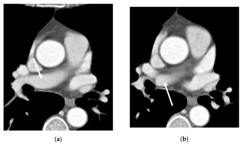 Diagnostics Free Full Text Arteria Praebronchialis Ap Found On