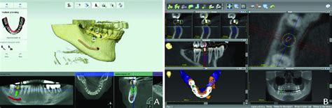 Planning Process Ideal Implant Position Set As Baseline For Accuracy