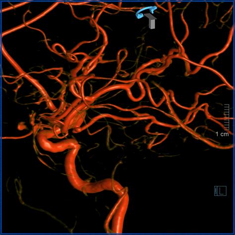 Anterior Choroidal Artery | neuroangio.org