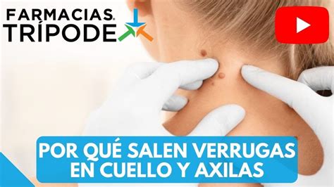 C Mo Eliminar Verrugas En El Cuello Por Qu Salen Verrugas En El