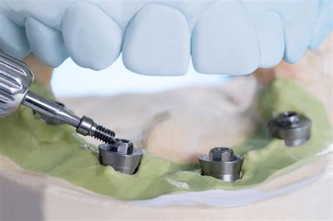 Qué tipo de titanio se utiliza en los implantes dentales Red