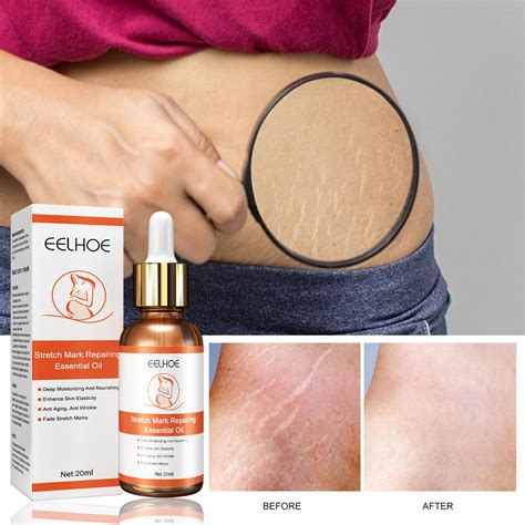 Wcucv 7 Days Marks Fading Body Oil For And Stretch Marks Skin Scar