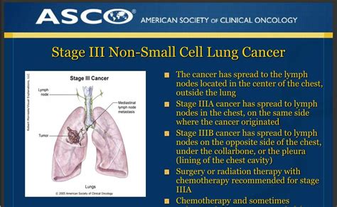 Stage 4 Lung Cancer Life Expectancy