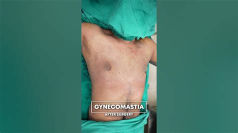 Gynecomastia Cure Gynecomastia Surgery Result Youtube