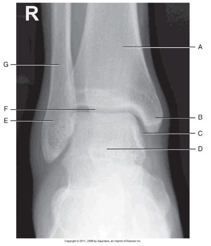 Ankle X-ray Flashcards | Quizlet