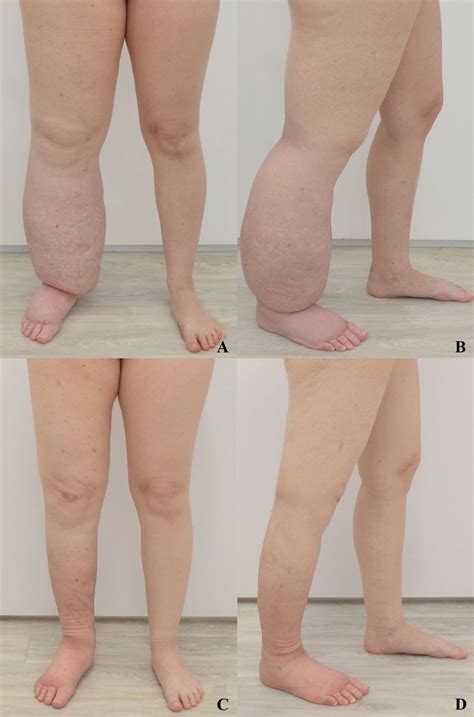 Lymphedema Before And After