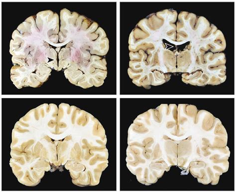 CTE identified in brain donations from young amateur athletes | National Institutes of Health (NIH)