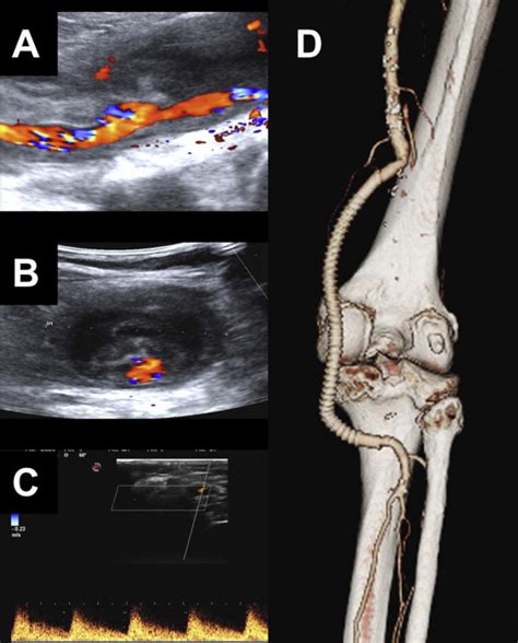 Urgent Mechanical Thrombectomy By Indigo System In Acute Thrombosed