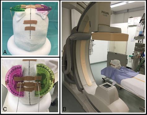 Figure 1 From Determining The Orientation Of Directional Deep Brain Stimulation Electrodes Using