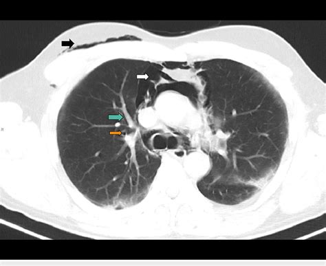 CT Scan Of The Chest From Day 3 Axial Slice Showing Air Around