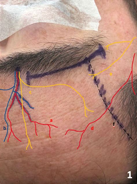 Skin Incision Between The Supraorbital Foramen With Its Supraorbital