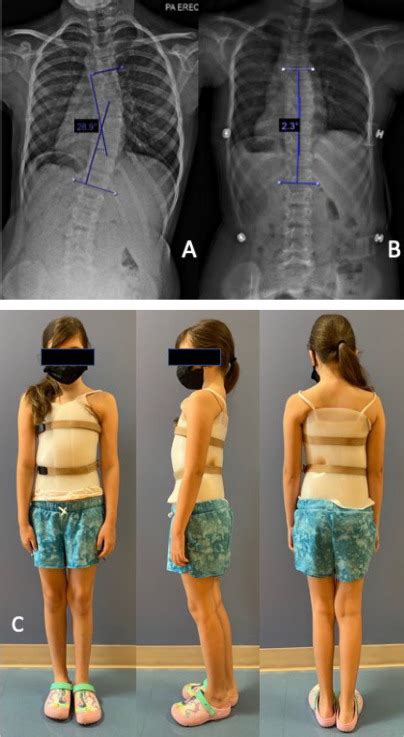 Update In Nonoperative Management Of Adolescent Idiopathic Scoliosis To