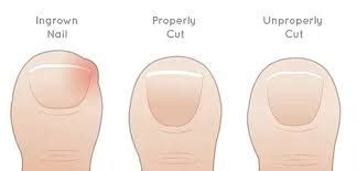 Avoid Ingrown Toenails by Knowing How They BeginYour Blog Title