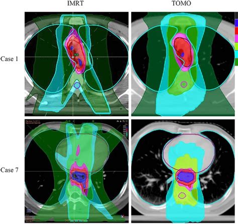 Dosimetric Comparison Between Helical Tomotherapy And Intensity